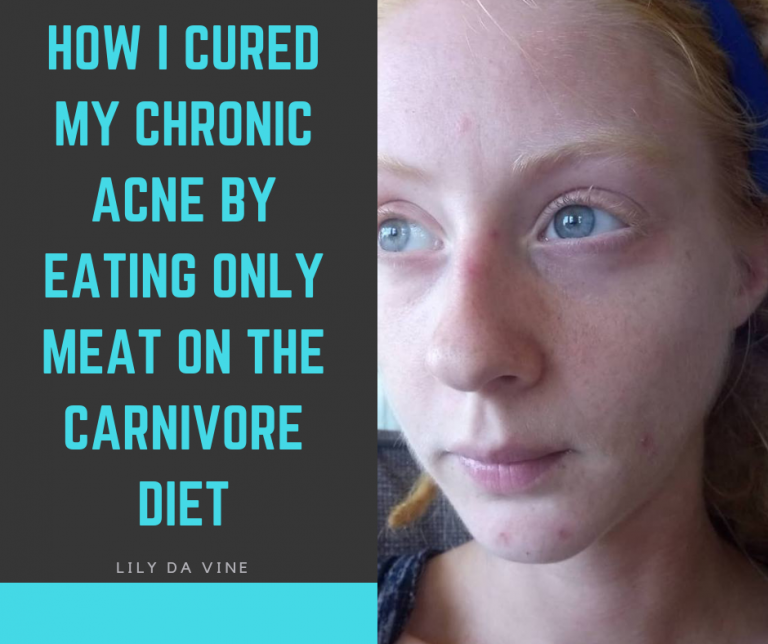 How I Cured My Cystic Acne by Eating Only Meat on the Carnivore Diet